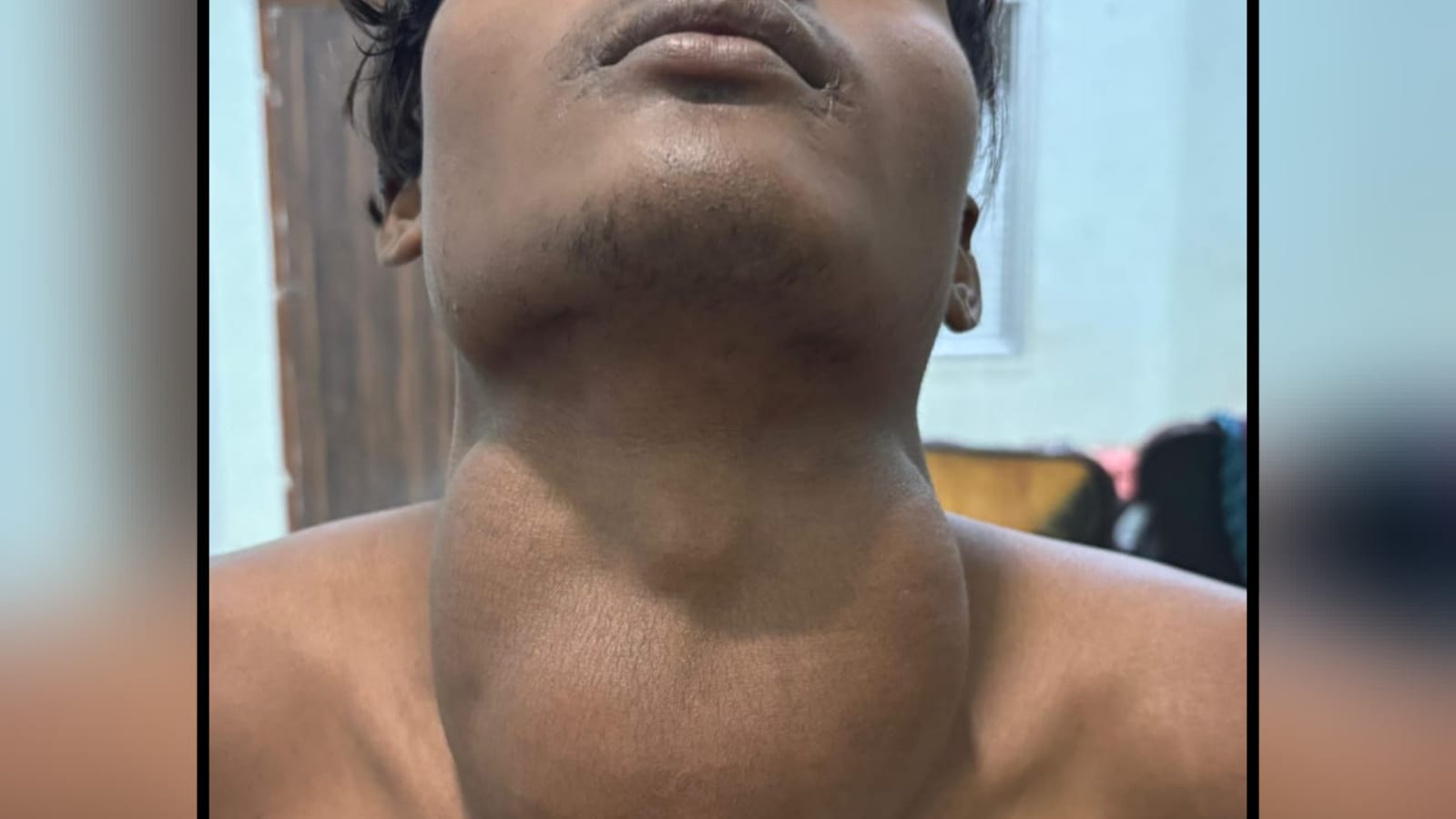 मेडिकल कॉलेज ने रचा इतिहास: गले से निकाली बड़ी गांठ, प्राचार्य कौशल ने टीम को दी बधाई